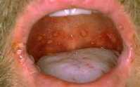 gonorrhea-mouth4