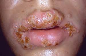 herpes-mouth3